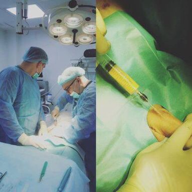 Trashja e penisit është e mundur me ndihmën e operacionit